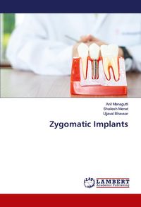 Produktbild: Zygomatic Implants
