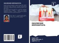 Produktbild: Okkljuziya Implantata