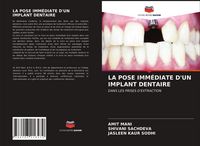 Produktbild: La Pose Imm&eacute;diate D'un Implant Dentaire