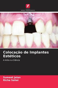 Produktbild: Coloca&ccedil;&atilde;o de Implantes Est&eacute;ticos