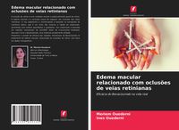 Produktbild: Edema macular relacionado com oclus&otilde;es de veias retinianas