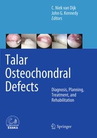 Produktbild: Talar Osteochondral Defects