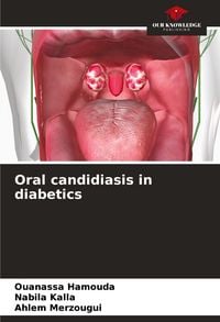 Produktbild: Oral candidiasis in diabetics