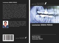 Produktbild: Lesiones Endo-Perio