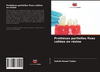 Produktbild: Proth&egrave;ses partielles fixes coll&eacute;es en r&eacute;sine