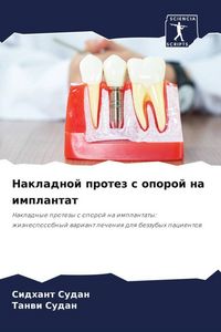 Produktbild: Nakladnoj protez s oporoj na implantat