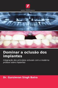 Produktbild: Dominar a oclus&atilde;o dos implantes