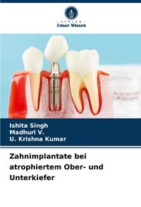 Produktbild: Zahnimplantate bei atrophiertem Ober- und Unterkiefer