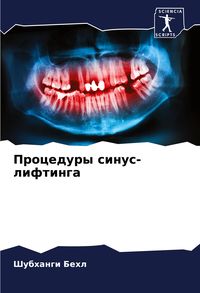Produktbild: Procedury sinus-liftinga