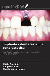 Produktbild: Implantes dentales en la zona est&eacute;tica