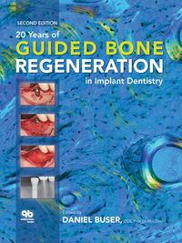 Produktbild: 20 Years of Guided Bone Regeneration in Implant Dentistry