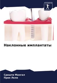 Produktbild: Naklonnye implantaty