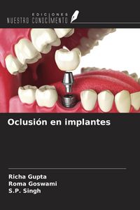 Produktbild: Oclusi&oacute;n en implantes