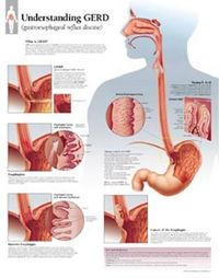 Produktbild: Understanding Gerd Chart 2nd/e