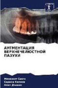 Produktbild: Augmentaciya Verhnecheljustnoj Pazuhi