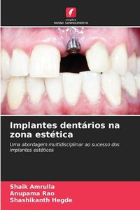 Produktbild: Implantes dent&aacute;rios na zona est&eacute;tica