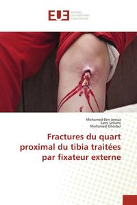 Produktbild: Fractures du quart proximal du tibia trait&eacute;es par fixateur externe