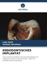 Produktbild: Endodontisches Implantat