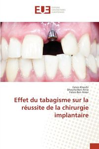 Produktbild: Effet du tabagisme sur la r&eacute;ussite de la chirurgie implantaire