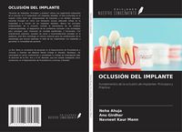 Produktbild: Oclusi&oacute;n Del Implante