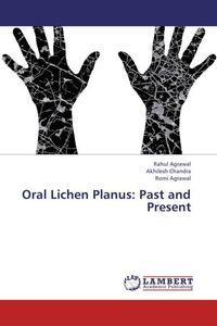 Produktbild: Agrawal, R: Oral Lichen Planus: Past and Present