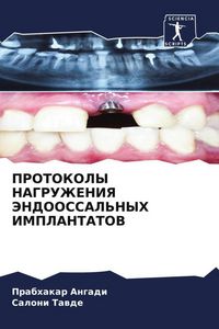 Produktbild: Protokoly Nagruzheniya Jendoossal'nyh Implantatov