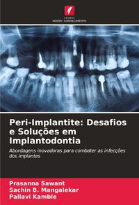 Produktbild: Peri-Implantite: Desafios e Solu&ccedil;&otilde;es em Implantodontia
