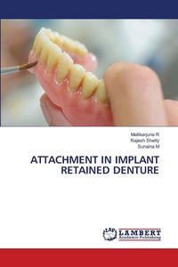 Produktbild: Attachment in Implant Retained Denture