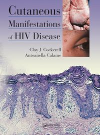 Produktbild: Cockerell, C: Cutaneous Manifestations of HIV Disease