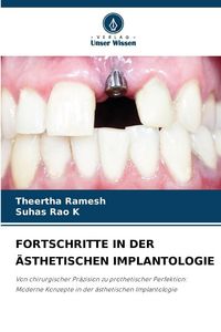 Produktbild: Fortschritte in der &Auml;sthetischen Implantologie