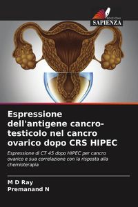 Produktbild: Espressione dell'antigene cancro-testicolo nel cancro ovarico dopo CRS HIPEC