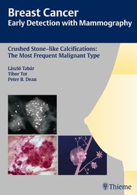 Produktbild: Breast Cancer: Early Detection with Mammography