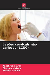 Produktbild: Les&otilde;es cervicais n&atilde;o cariosas (LCNC)