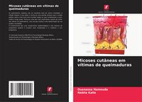 Produktbild: Micoses cut&acirc;neas em v&iacute;timas de queimaduras