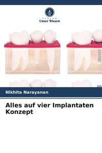 Produktbild: Alles auf vier Implantaten Konzept