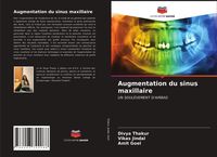 Produktbild: Augmentation du sinus maxillaire