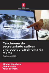 Produktbild: Carcinoma do secretariado salivar an&aacute;logo ao carcinoma da mama