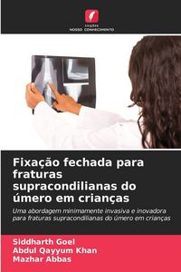 Produktbild: Fixa&ccedil;&atilde;o fechada para fraturas supracondilianas do &uacute;mero em crian&ccedil;as