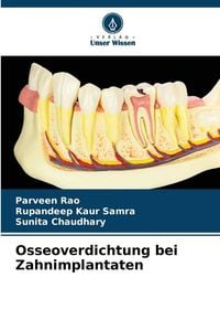 Produktbild: Osseoverdichtung bei Zahnimplantaten