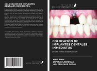 Produktbild: Colocaci&oacute;n De Implantes Dentales Inmediatos