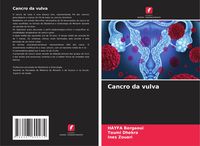 Produktbild: Cancro da vulva