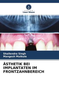 Produktbild: &Auml;sthetik bei Implantaten im Frontzahnbereich