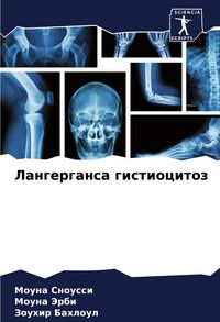 Produktbild: Langergansa gistiocitoz