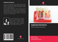 Produktbild: Implantes Dent&aacute;rios