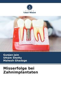 Produktbild: Misserfolge bei Zahnimplantaten