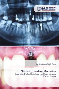 Produktbild: Mastering Implant Occlusion