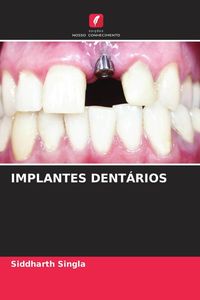 Produktbild: Implantes Dent&aacute;rios