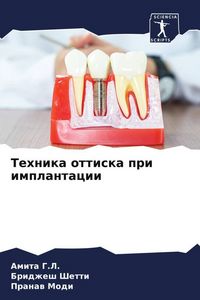 Produktbild: Tehnika ottiska pri implantacii