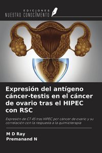 Produktbild: Expresi&oacute;n del ant&iacute;geno c&aacute;ncer-testis en el c&aacute;ncer de ovario tras el HIPEC con RSC