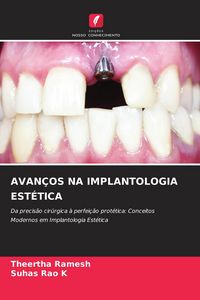 Produktbild: AVAN&Ccedil;OS NA IMPLANTOLOGIA EST&Eacute;TICA